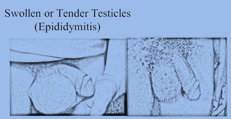 What are the treatment options for swollen testicles?